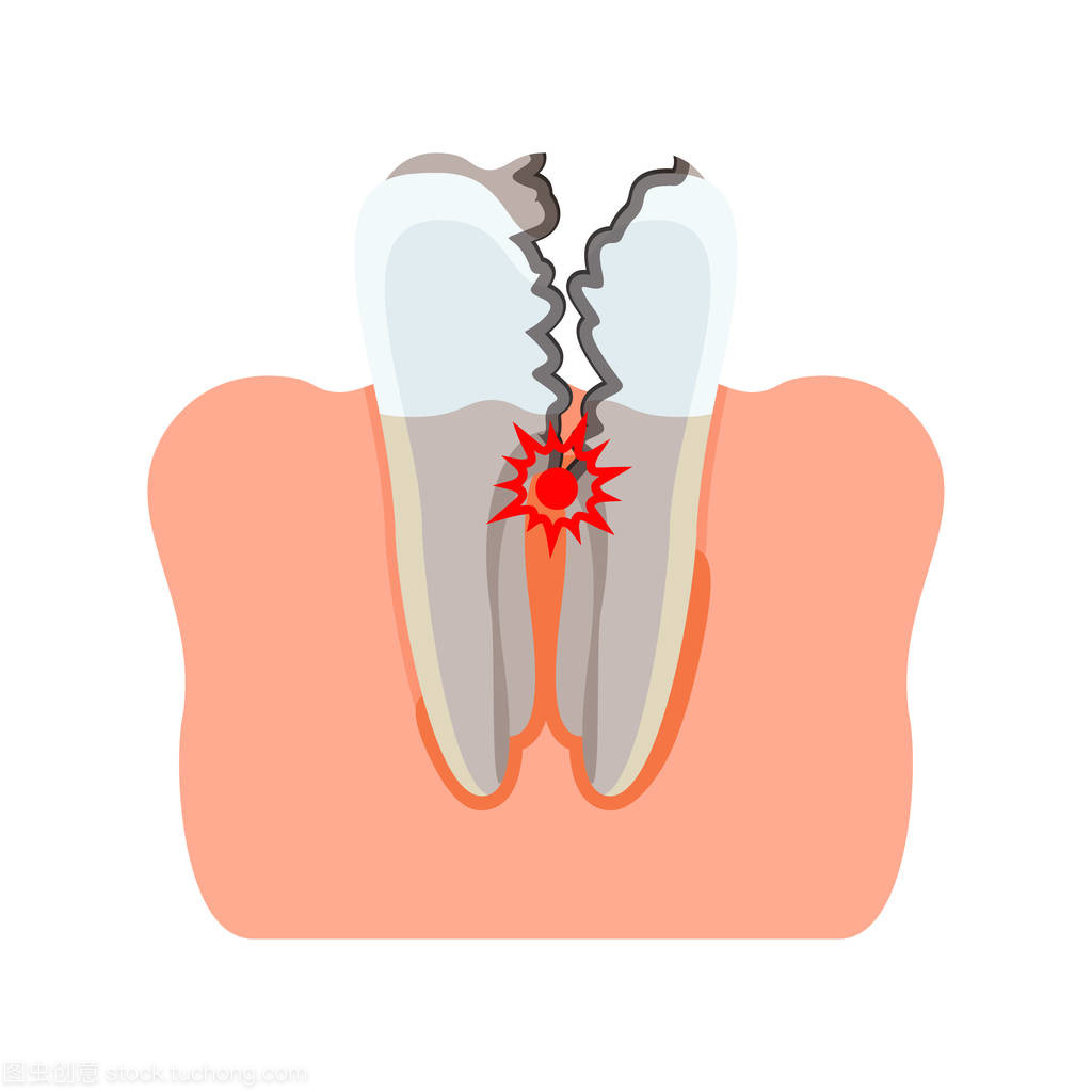 雅悦齿科解析：为何孩子会有牙痛困扰？